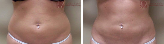 Abdominal Liposuction Fort Worth
